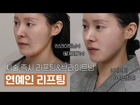 오앤 티타늄 리프팅: 연예인이 찾는 즉시 리프팅 브라이트닝 효과