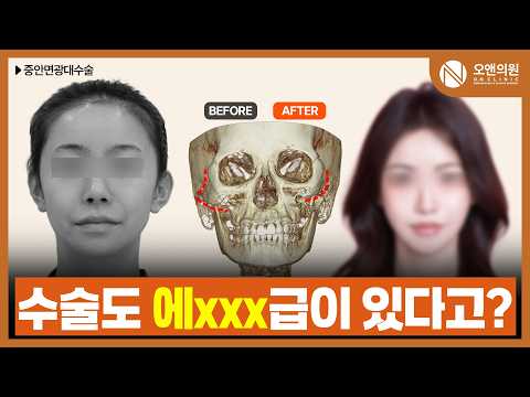 중안면 광대 축소 수술: 타병원 윤곽 3종 후 재수술로 완성하는 얼굴 라인