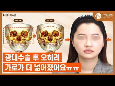 ON Clinic Zygoma Revision: A Case Where the Face Got Even Wider