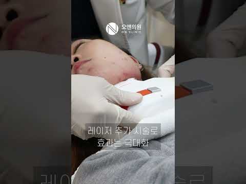 20살, 인생 첫 시술로 선택한 오앤 각주사! 인생 첫 시술 후기