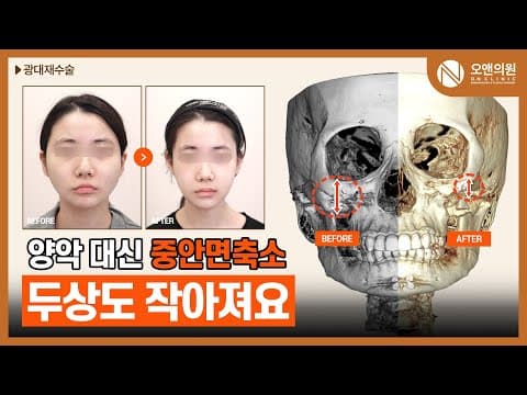 광대 재수술 (뼈틈): 양악 대신 중안면축소로 두상도 작아져요