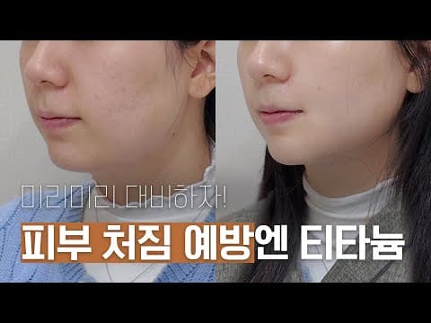 오앤 티타늄 리프팅으로 처짐 예방: 미리미리 대비하는 비결