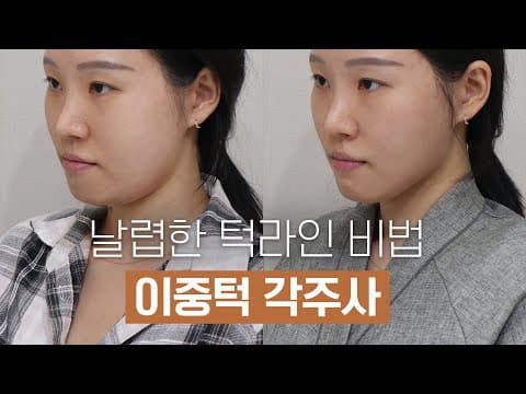 이중턱 각주사 시술 후기: 레이저 부스터 병행으로 V라인 완성