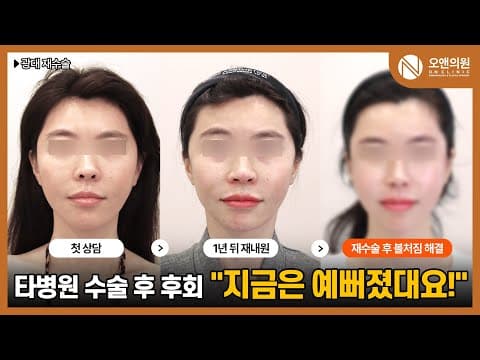 On面部轮廓颧骨修复，显老脸庞的逆袭记录