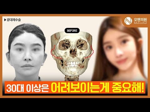 오앤 안면윤곽 광대재수술: 피부 처짐까지 개선된 동안 얼굴