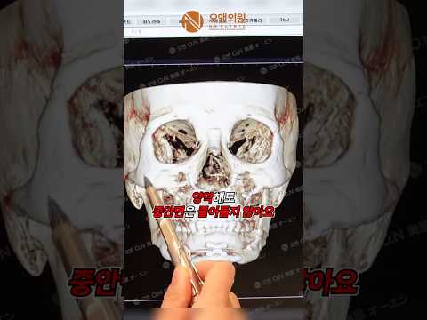 중안면 축소술: 양악 수술처럼 광대뼈를 줄여 눈이 커지는 효과