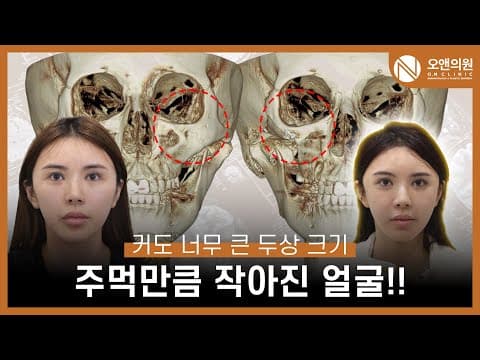 颧骨中面部缩小手术：脸小如拳头，头型太大也能改善