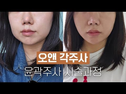 오앤의원 윤곽주사 시술 과정: '각주사' 시술과 효과 한눈에
