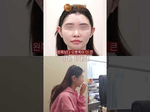 광대뼈 축소 재수술: 넓적한 얼굴과 비대칭 개선, 입체 재수술