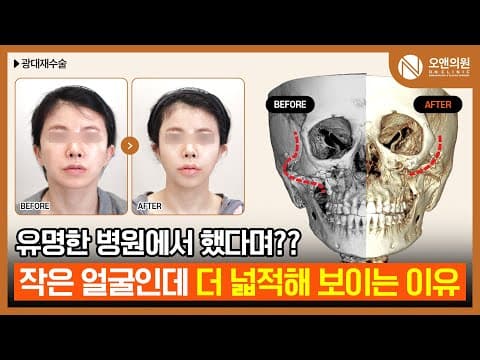 광대 재수술: 유명 병원 수술 후 작은 얼굴이 더 넓적해진 이유