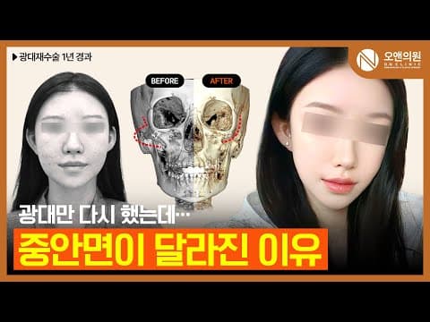 颧骨再手术后脸部长度与头型变化：术后1年记录