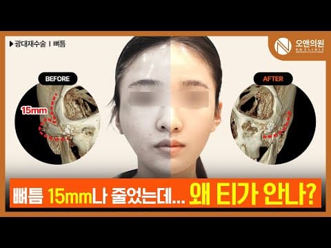 광대 재수술 (뼈틈) - 심한 비대칭과 뼈틈 개선