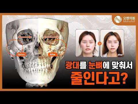 오앤 안면윤곽 광대중안면축소수술: 광대를 눈뼈에 맞춰 줄이는 사례