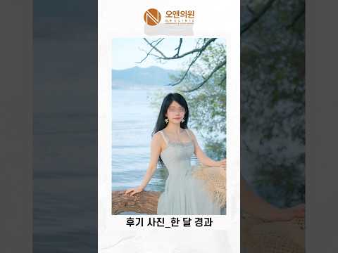 중국 광대 수술 후 넙적해진 얼굴 재수술: 작은 얼굴 넓적해진 이유