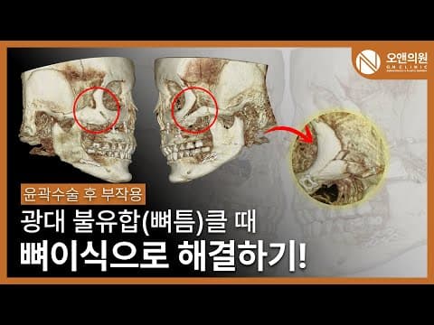 骨缝（不愈合）骨移植：副作用严重时的颧骨重建
