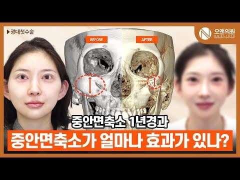 오앤 안면윤곽 광대중안면축소수술: 중안면축소 1년 경과 효과