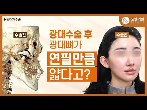 オーアン顔面輪郭 頬骨中顔面縮小術：頬骨が鉛筆ほど薄くなった症例