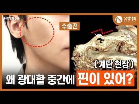 Cheekbone Revision Surgery: Fixing the Step Deformity From Fixation Pins