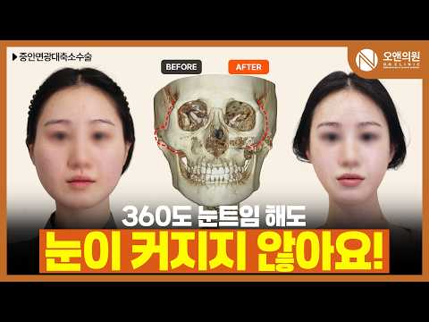 중안면광대축소수술로 길고 넓은 얼굴 개선: 눈도 함께 커지는 효과