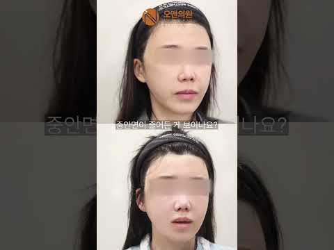 중안면축소 재수술, 뼈에 구멍 뚫린 얼굴을 10mm 이상 줄이다