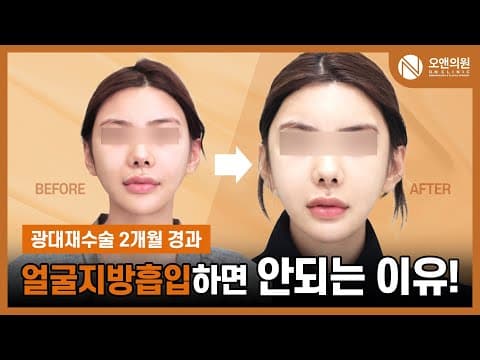 광대 재수술 (비대칭, 불유합) 후 관자 돌출 및 볼처짐 해결