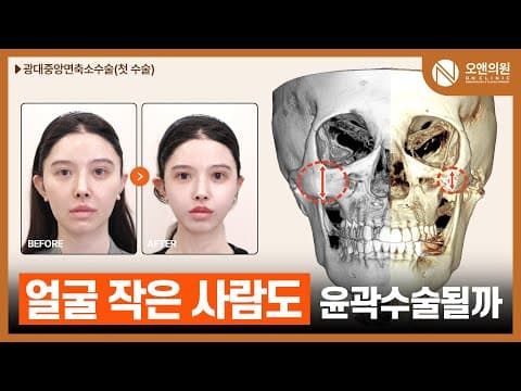 오앤 안면윤곽 광대 중안면 축소 수술: 얼굴 작아도 윤곽 가능?