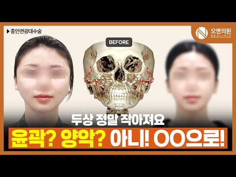 광대재수술 후 미스코리아 얼굴형으로 변신: 두상까지 작아진 결과