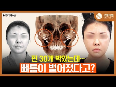 광대 재수술 후 뼈가 벌어지고 염증까지 심했던 환자의 놀라운 회복