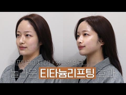 오앤 티타늄 리프팅: 슈링크 vs 티타늄, 오앤 티타늄에 정착