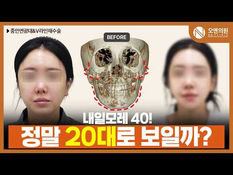 동안 효과 안면윤곽: 중안면광대축소와 V라인 수술 후 20대 소리 듣는 환자 후기