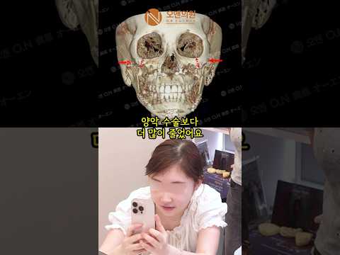 Facial Contouring Patient at Week 3: Amazed by Bigger Eyes and Symmetry
