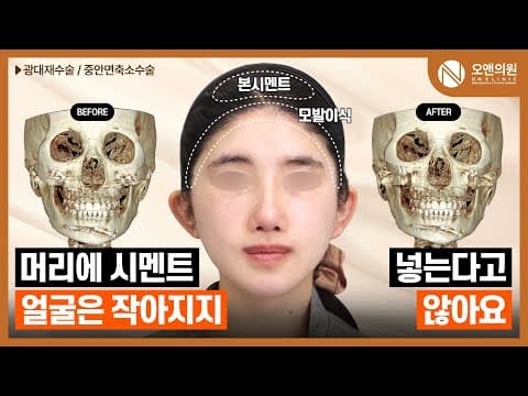Zygoma Midface Reduction: Even Cementing Your Head Won't Make Your Face Smaller