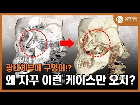 颧骨再手术：颧骨体部空洞骨移植，为什么总是这种棘手案例？