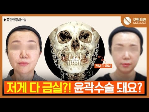 50대 안면윤곽, 유지인대 끌어올리는 중안면광대축소술