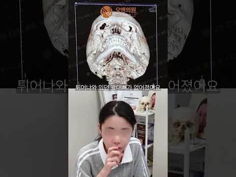 Told a Large Head Rules Out Zygoma Surgery? It Is Possible at ON Clinic!