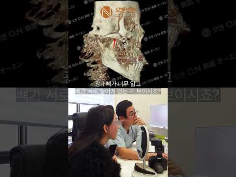 얇은 광대뼈 재수술 성공 사례: 연필만큼 얇아진 광대 재건