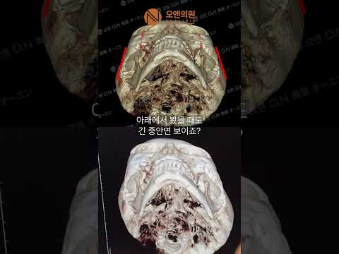 改善长中面部与颧骨不对称手术：纵向长脸的解决方案