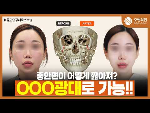 오앤 안면윤곽 중안면광대축소수술: 광대로 중안면 작아지는 비결