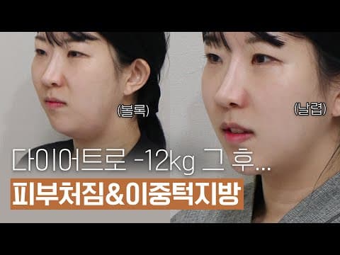 오앤의원 각주사, 그 비법은? 급격한 체중 감량 후 볼륨감과 피부 처짐 해결