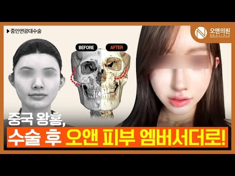오앤 안면윤곽 중안면광대수술: 중국 왕홍의 오앤 엠버서더 후기