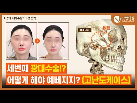 Cheekbone Revision: A Tough Third Operation for a Woman in Her Late 30s