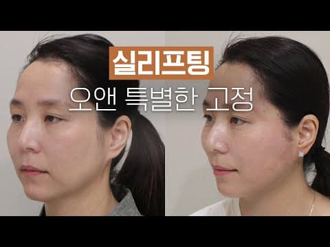 오앤 실리프팅: 처진 얼굴 개선을 위한 특별한 고정 방식