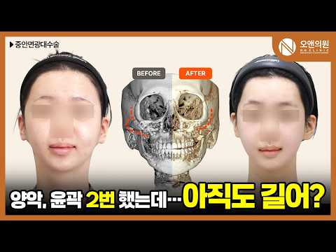 광대재수술: 눈뼈보다 튀어나온 광대뼈, 뼈가 없는 상태에서 1.5cm씩 총 3cm 축소