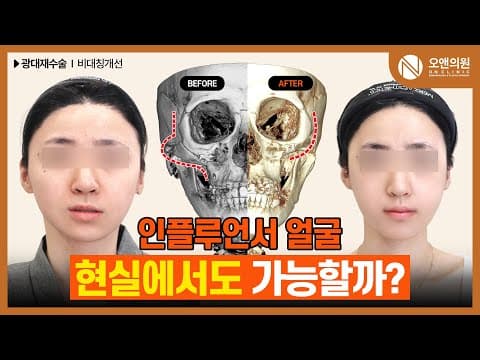 颧骨修复手术：打造你理想脸型的定制化颧骨修复手术