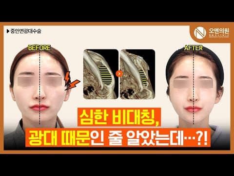 Midface Zygoma Surgery: Why Your Face Looks Bigger After Contouring