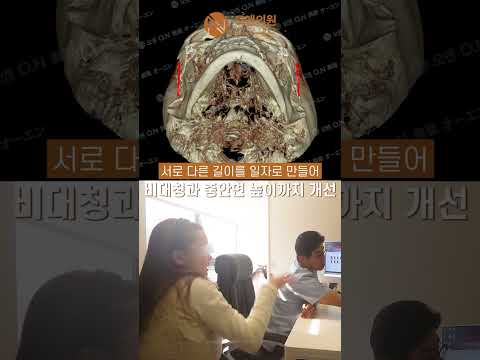 기존 광대 수술의 부작용으로 인한 비대칭과 과도한 핀 문제를 해결한 재수술 사례