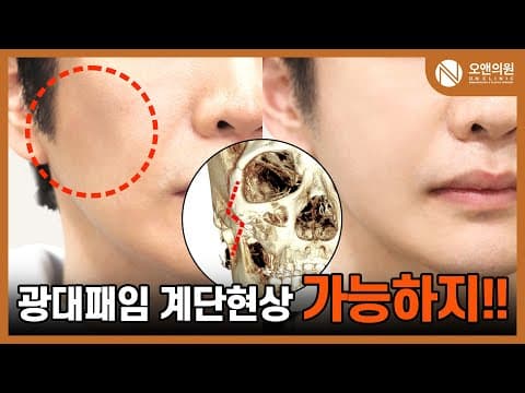 광대 재수술 (계단 현상): 광대패임 계단현상 가능 사례