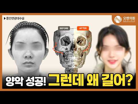 양악 후에도 넓은 얼굴, 중안면 광대 수술로 해결한 케이스