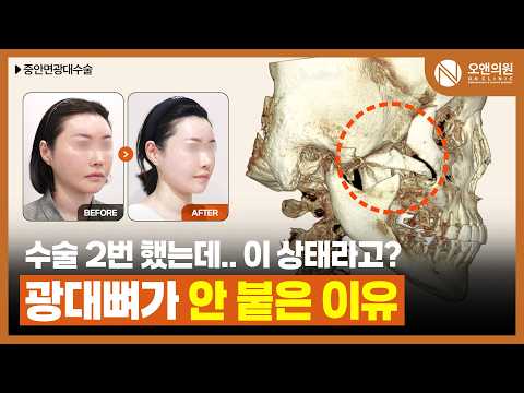 광대재수술: 과거 불유합으로 뼈가 아예 떨어져 있던 환자의 드라마틱한 변화