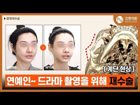 颧骨再手术后阶梯现象，为艺人拍摄做3D颧骨缩小术